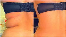 U-Lipo Result 1