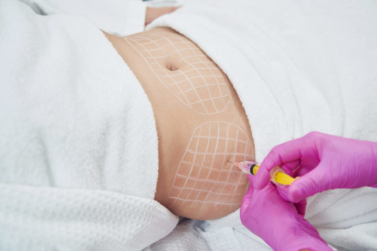 Non-Surgical Fat Reduction Treatments